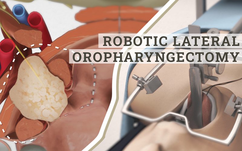 Robotic lateral oropharyngectomy