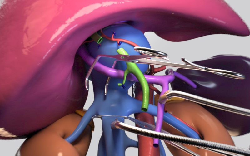 Segments 1/6/7 ex vivo liver resection with veno-veno bypass for caval sarcoma