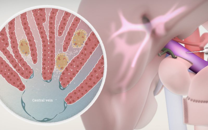 Total pancreatectomy with islet auto-transplant