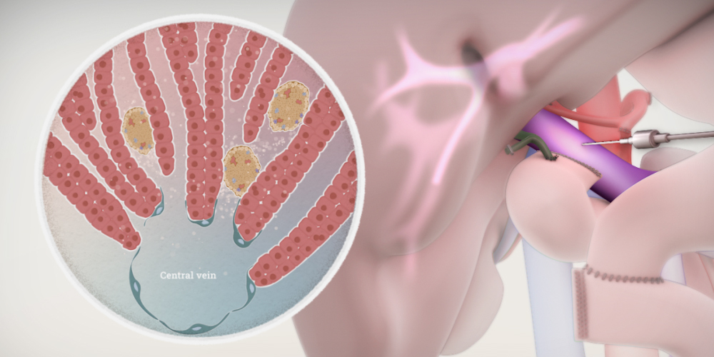 Total pancreatectomy with islet auto-transplant