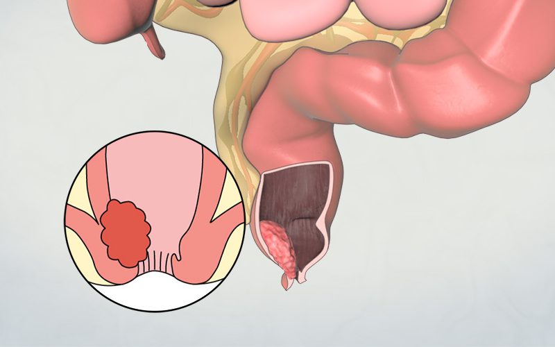 Patient Learning: Abdominoperineal Resection