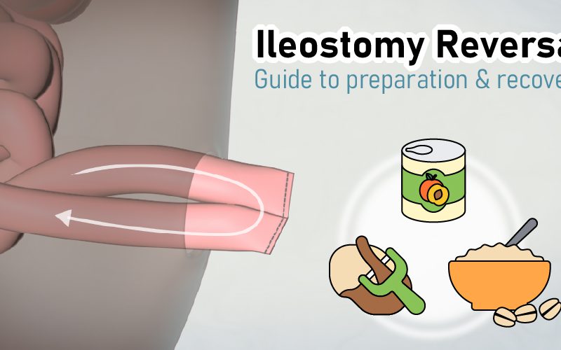 Patient Learning: Ileostomy Reversal
