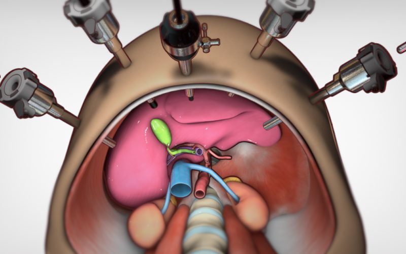 Robotic Segment 6 Liver Resection